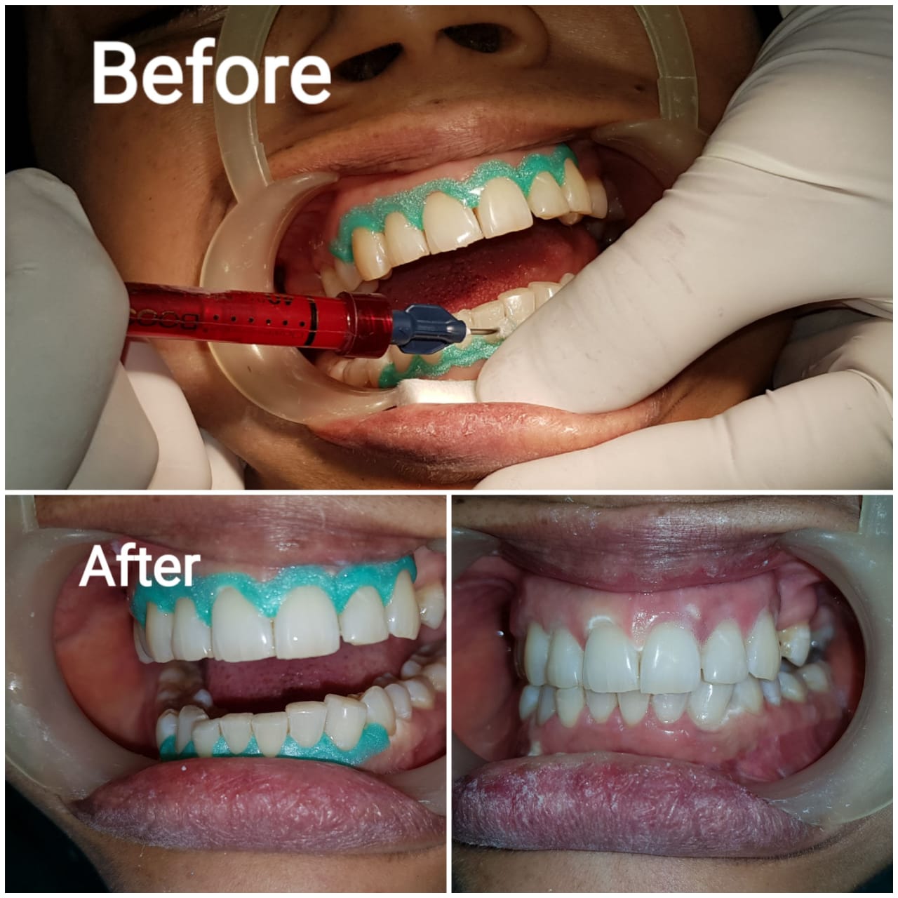 Before and after dental treatment close-up showing work in progress and a completed result